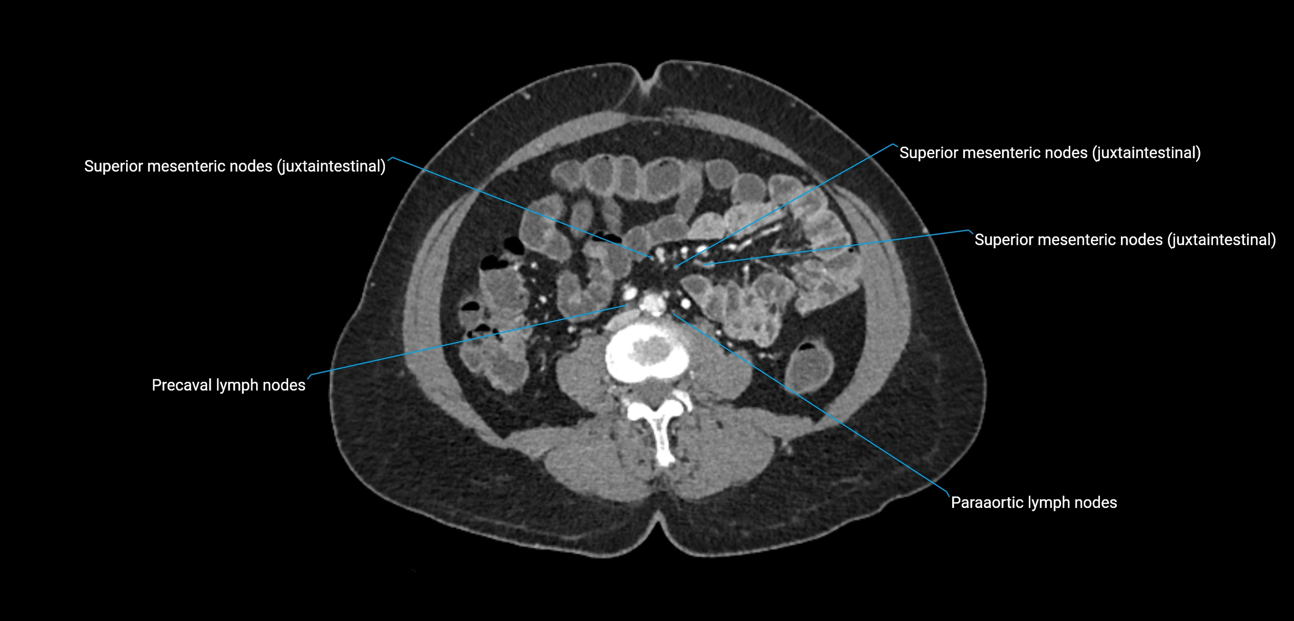 CT ct abdominal lymph nodes  axial cross sectional anatomy  enchanced radiology image -img-00002-00249.webp